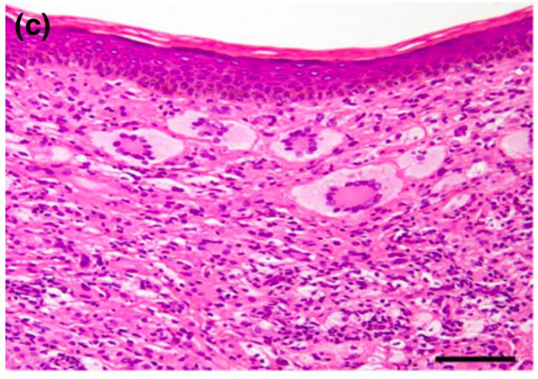 【Journal of Dermatology病例赏析】普罗布考治疗多发性成人黄色肉芽肿1例