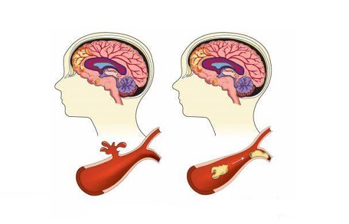 短暂性脑缺血疾病病因
