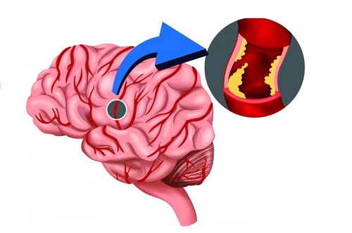 什么是脑梗死？