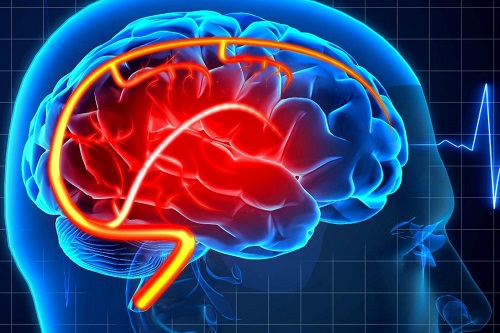 Neurology重磅发文：为普罗布考打开一扇窗？