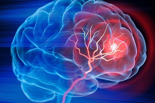 Lancet Neurol：脑出血高风险患者如何选用抗血小板和降脂药物？