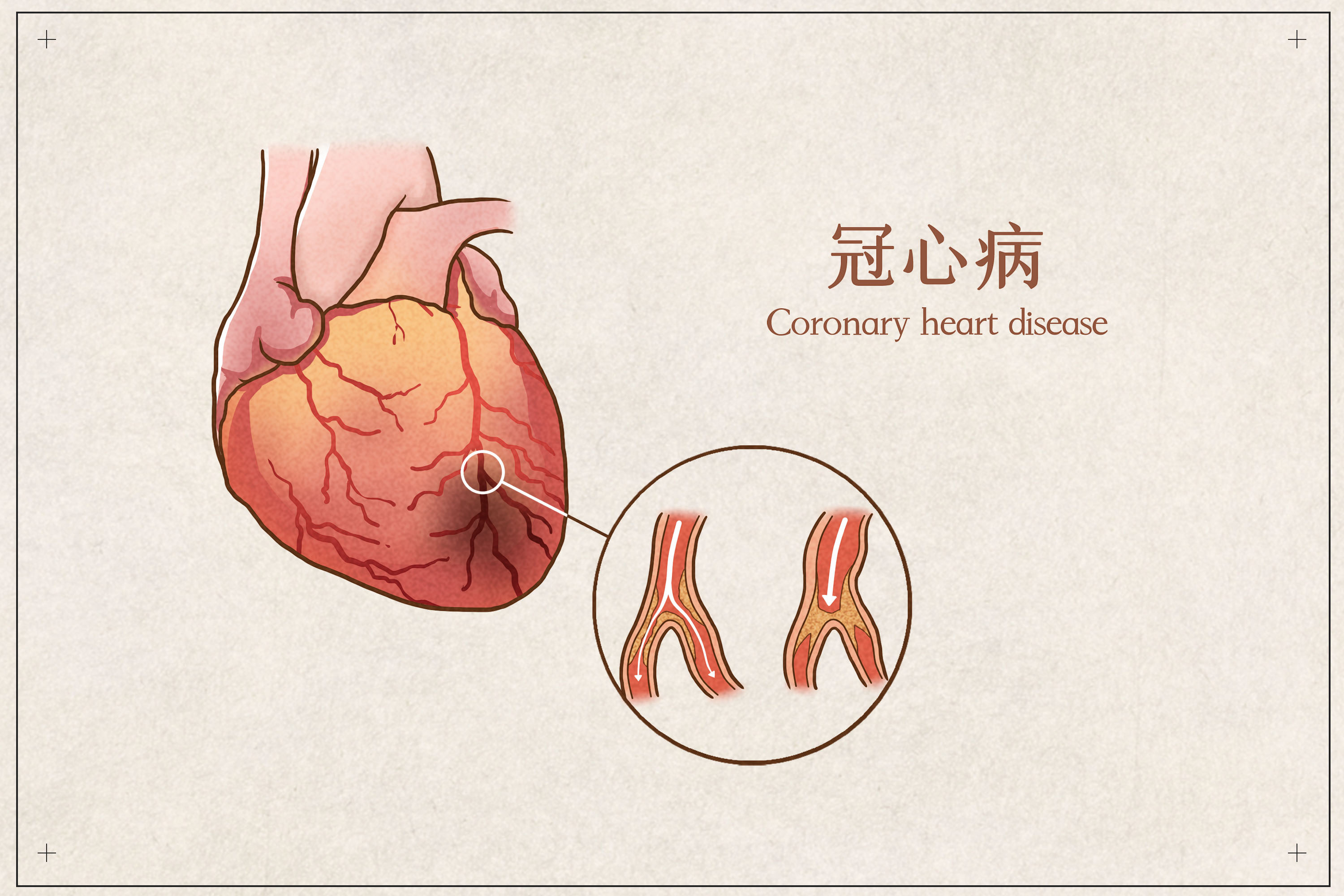 得了冠心病还能运动吗