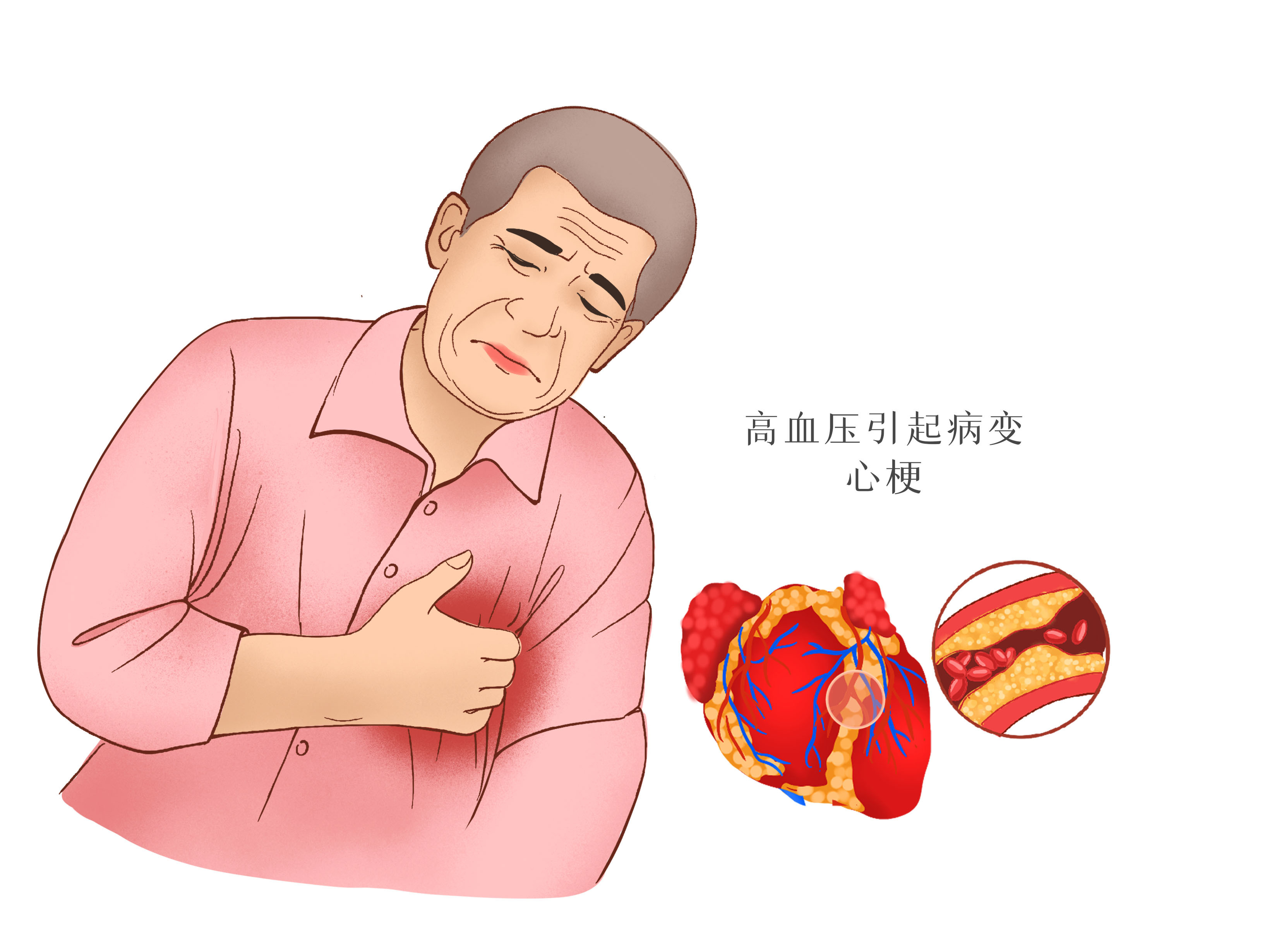 如何避免心梗复发？