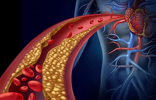 新指南明确：普罗布考成糖尿病高胆固醇血症的“优先选择”